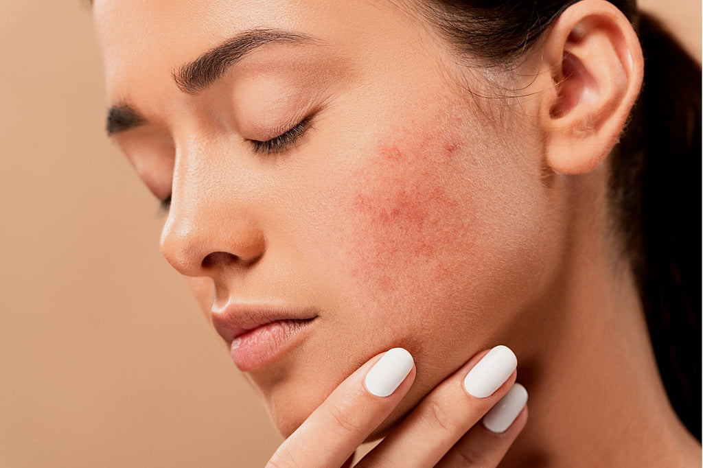 The Ultimate Guide to Care For Acne-Prone Skin